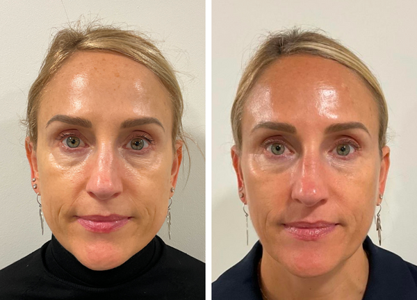 From Fine Lines to Flawless 