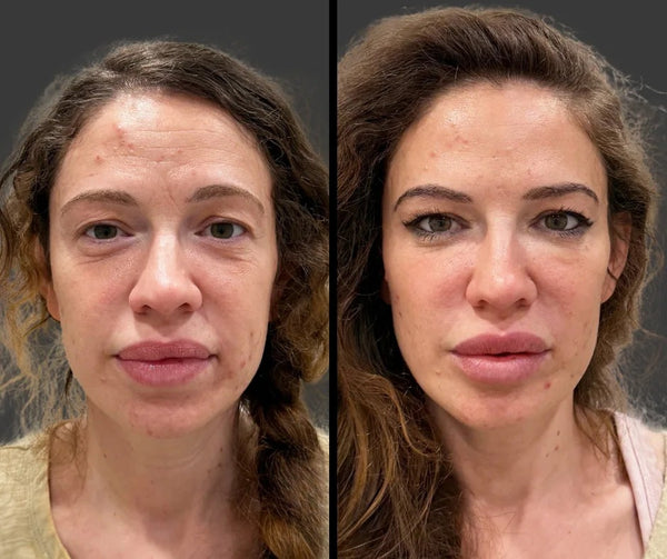 From Fine Lines to Flawless 