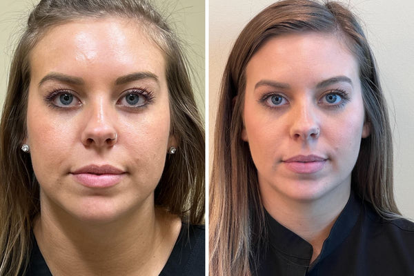 From Fine Lines to Flawless 