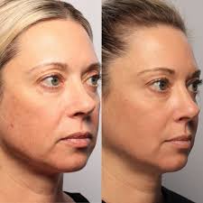 From Fine Lines to Flawless 